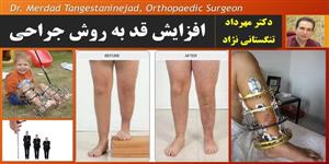 افزایش قد به روش جراحی