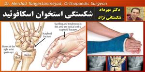 شکستگی استخوان اسکافوئید شکستگی استخوان اسکافوئید