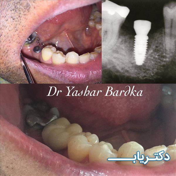 نمونه کار دکتر یاشار بردکا 4