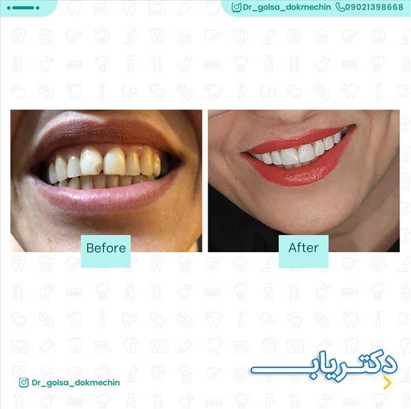 نمونه کار دکتر گلسا دکمه چین 4