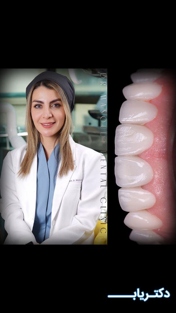 نمونه کار دکتر بهاره مسعودی دندانپزشک زیبایی