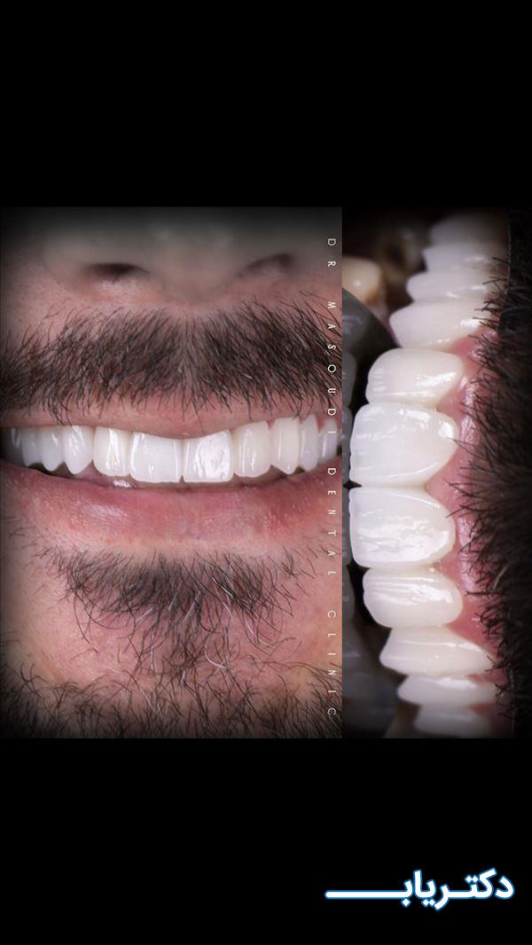 نمونه کار دکتر بهاره مسعودی دندانپزشک زیبایی 3