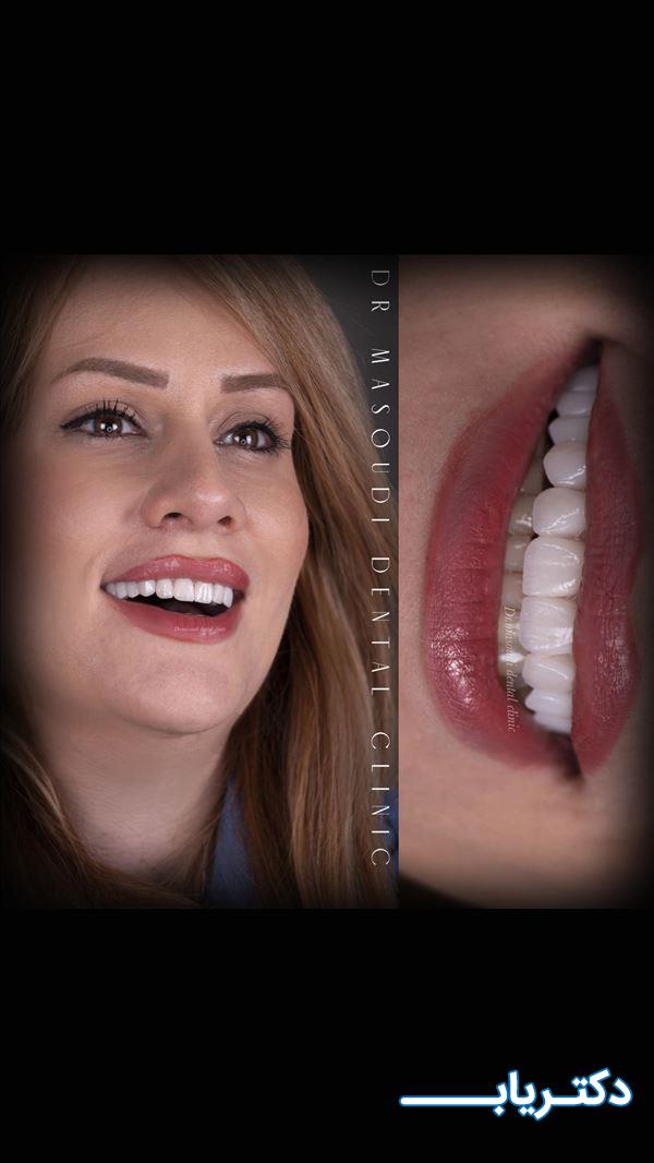 نمونه کار دکتر بهاره مسعودی دندانپزشک زیبایی