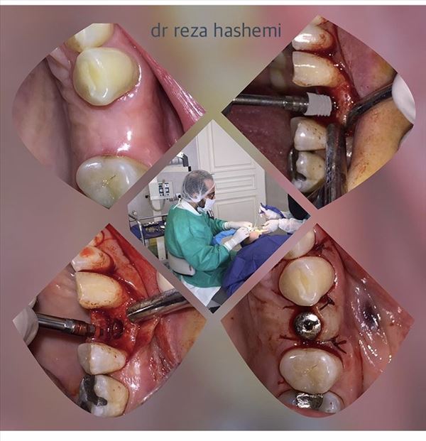 نمونه کار دکتر مرکز دندانپزشکی آرام 1