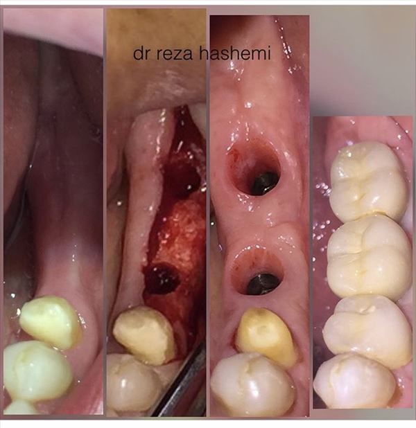 نمونه کار دکتر مرکز دندانپزشکی آرام