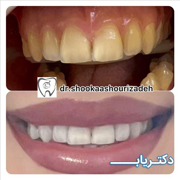 نمونه کار دکتر شوکا عاشوری زاده